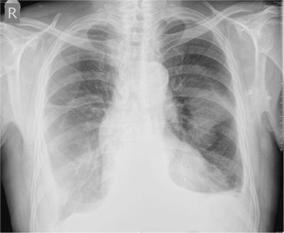 Onset of Microscopic Polyangiitis in Binephrectomied Patient on Chronic Hemodialysis—Case Report